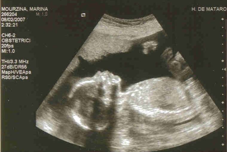 20 недель беременности | клиника ведения беременности в пятигорске