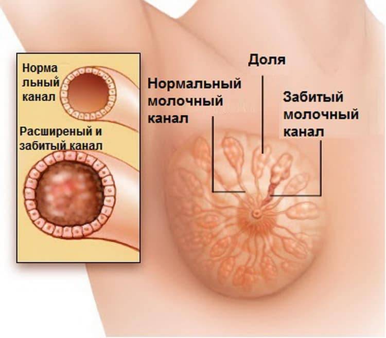 Ушибы и гематомы молочной железы | университетская клиника