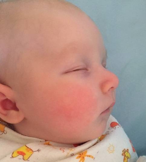 Ребенку год красные щеки. Диатез на щеках у новорожденных.