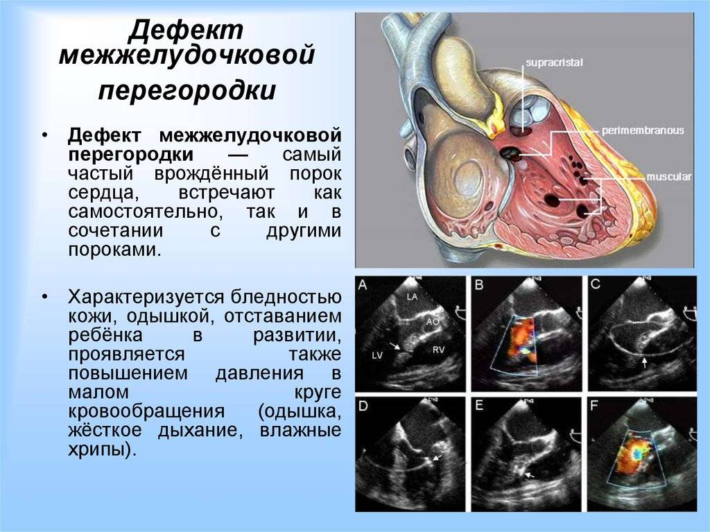 Открытый артериальный проток и дмжп