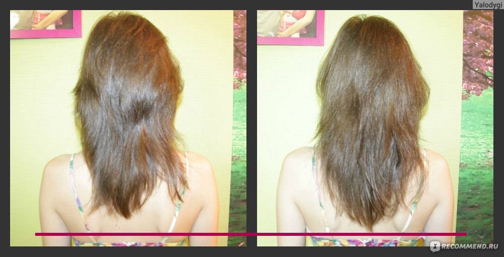 Выпадение волос во время и после беременности — норма ли это?