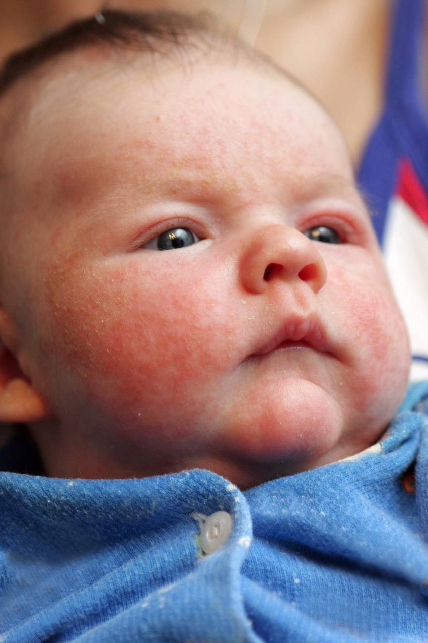 Аллергия у новорожденного на смесь | как проявляется аллергия при грудном вскармливании | nutrilak