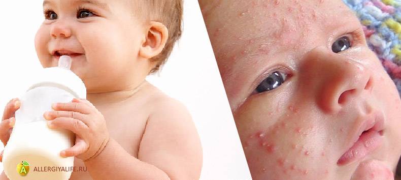 Аллергия у детей: признаки, симптомы и способы лечения