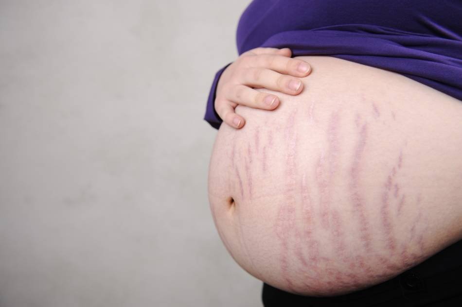 Растяжки после родов: причины, диагностика, лечение, профилактика