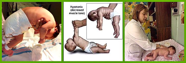 Нарушения мышечного тонуса у детей: гипотонус, гипертонус, дистония