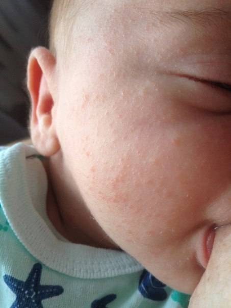 Сыпь на животе у ребенка: разновидности и возможные причины