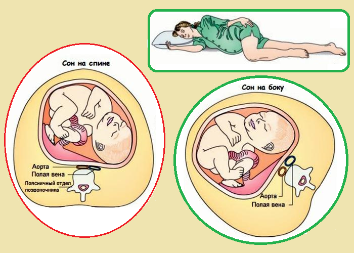 Гипотония при беременности — причины и симптомы, безопасные методы лечения
