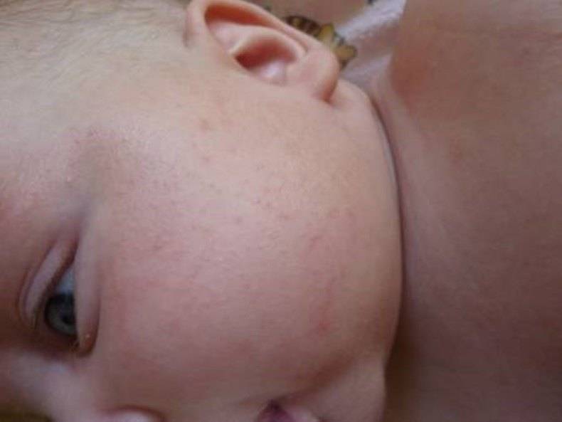 Как отличить потницу от аллергии у грудничка: 13 отличий, симптомы, советы по уходу за кожей детей