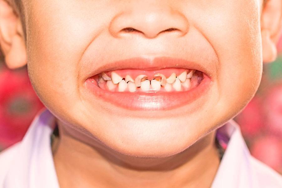 Почему портятся зубы - причины кариеса | клиника эксперт
