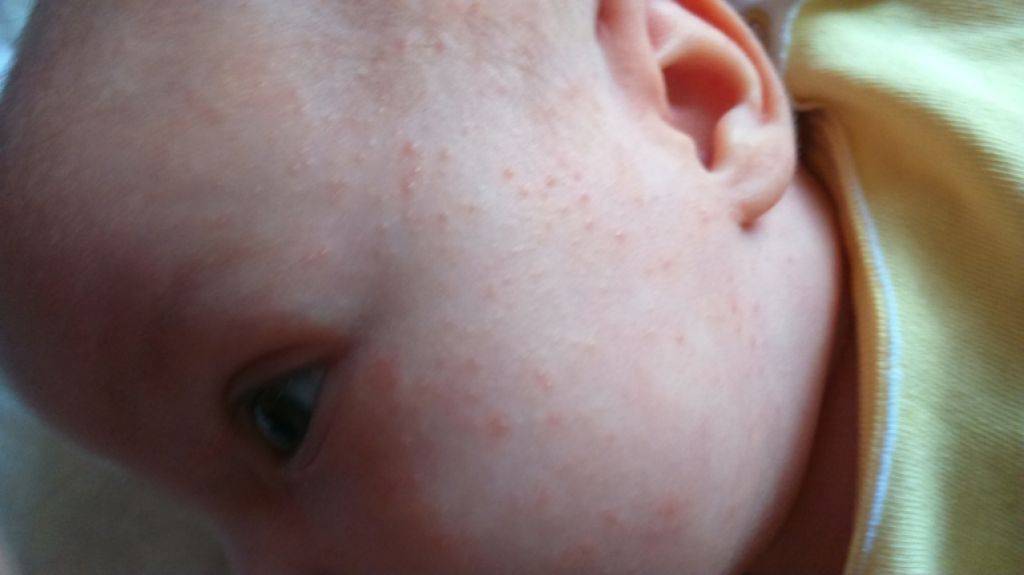 Аллергия на грудное молоко у ребенка и мамы - причины и следствия