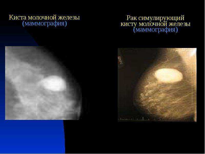 Фиброзно-кистозная мастопатия: диагностика и лечение | пункция молочной железы в санкт-петербурге