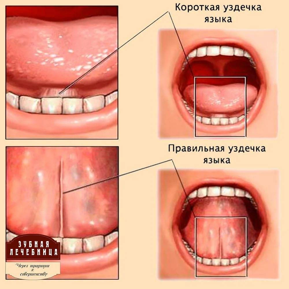 Пластика уздечки языка и губ