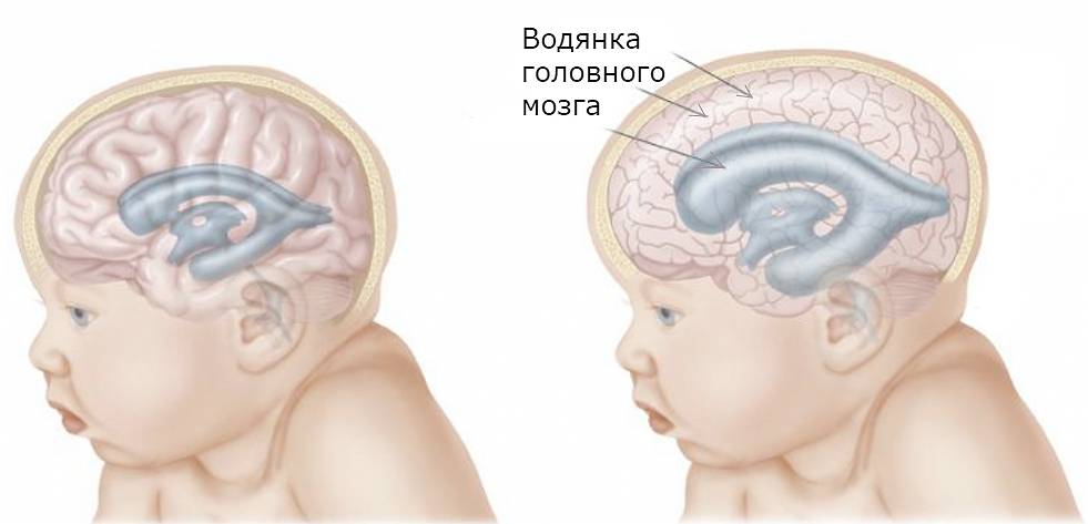 Ультразвуковые особенности структурных изменений головного мозга новорожденных с внутриутробной герпес-цитомегаловирусной инфекцией