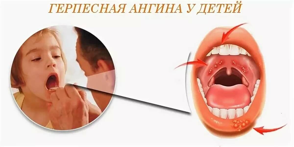 Герпесная ангина - симптомы: лечение герпетической ангины у взрослых | имудон