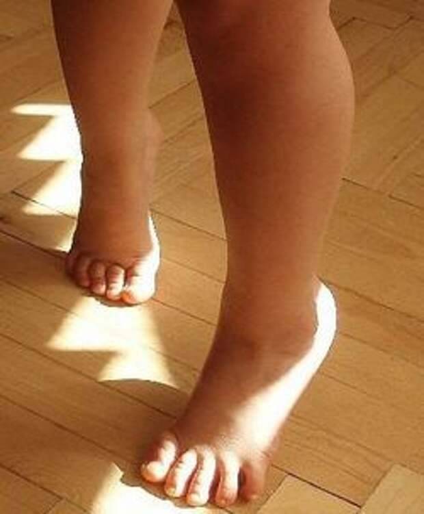 Генетические факторы, ассоциированные с ходьбой на носках у детей | nasdr