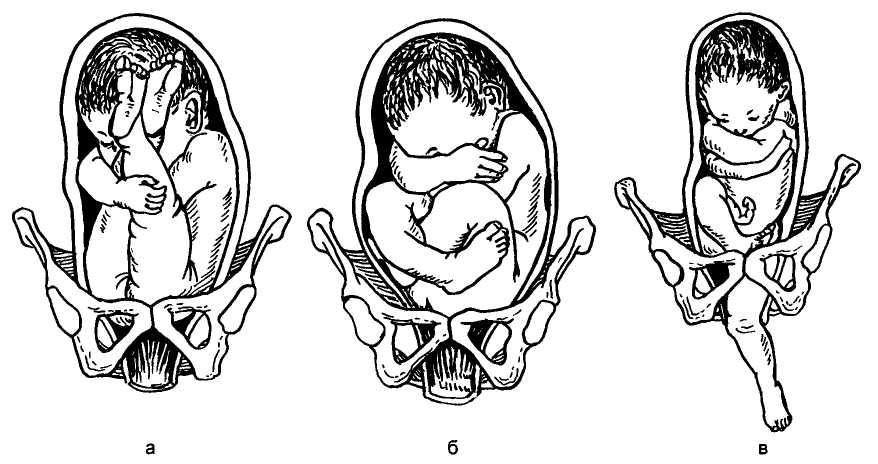 Глава 12. беременность и роды при тазовых предлежаниях плода