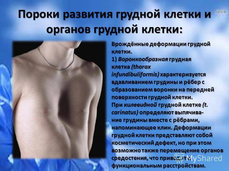 Деформация грудной клетки у детей: причины, симптомы, лечение