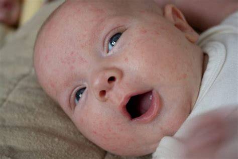Аллергия на гречку у ребенка — аллергия