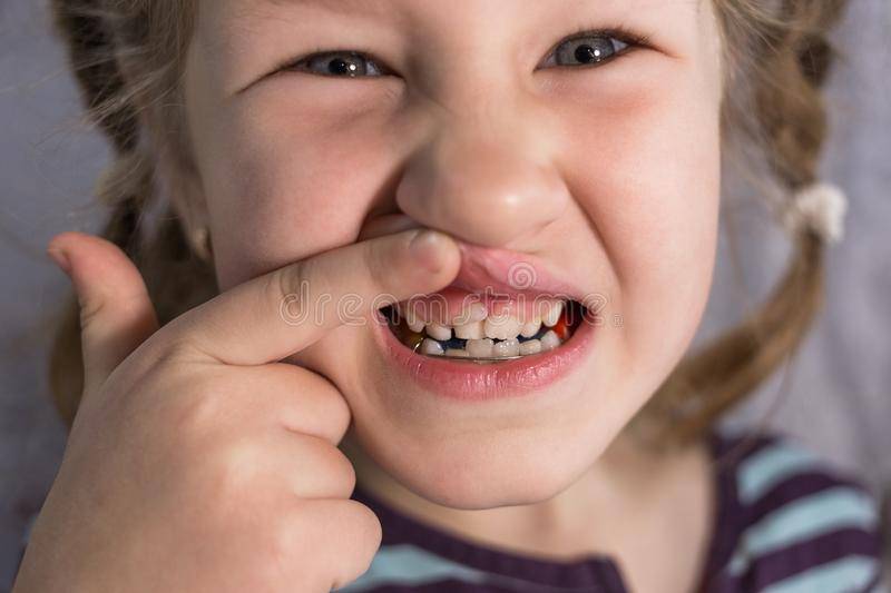 Трещины на зубах: что делать, если треснула зубная эмаль, как убрать проблему и чем лечить
