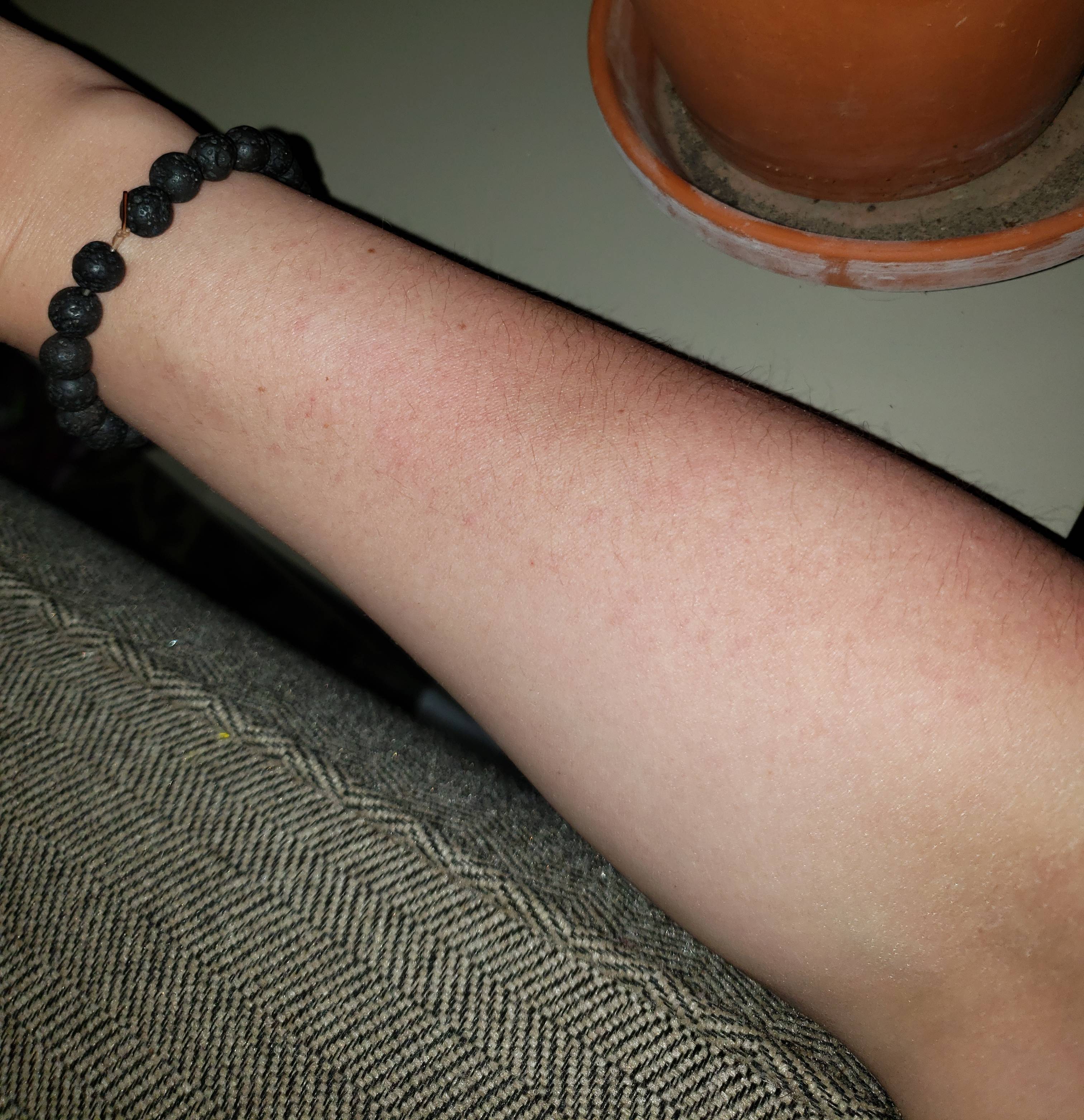 Аллергия на солнце: правда или вымысел?