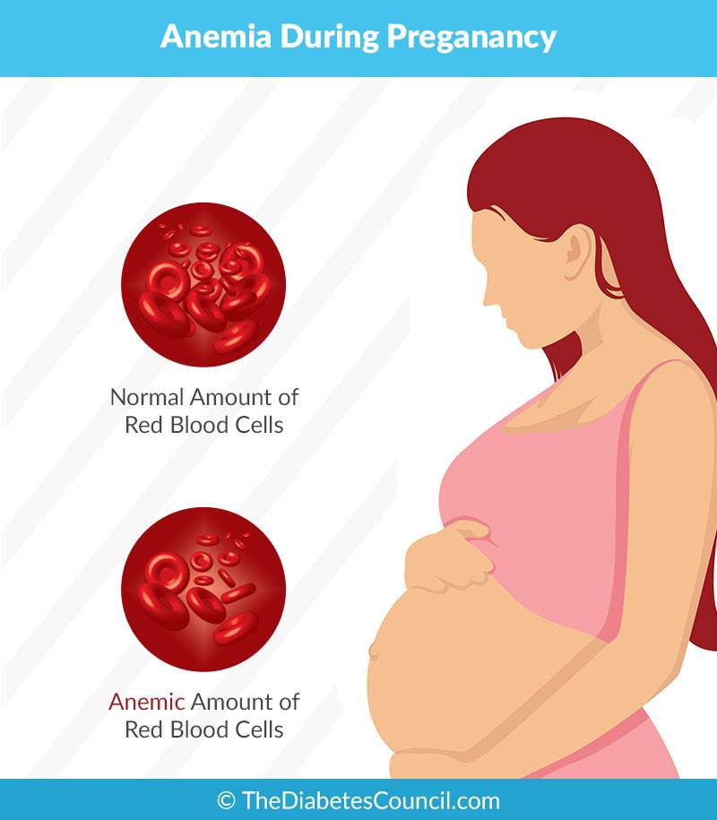 Железодефицитная анемия во время беременности