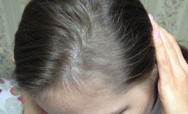 Выпадение волос после родов, что делать?