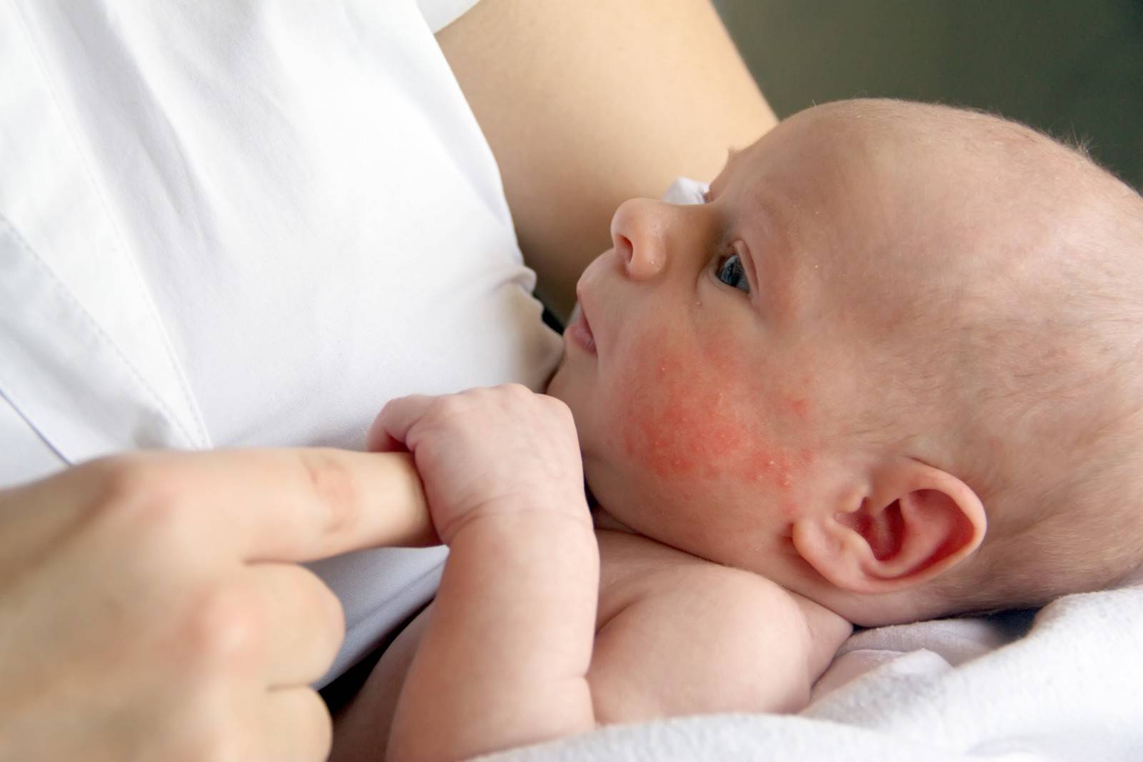 Аллергия у новорожденного