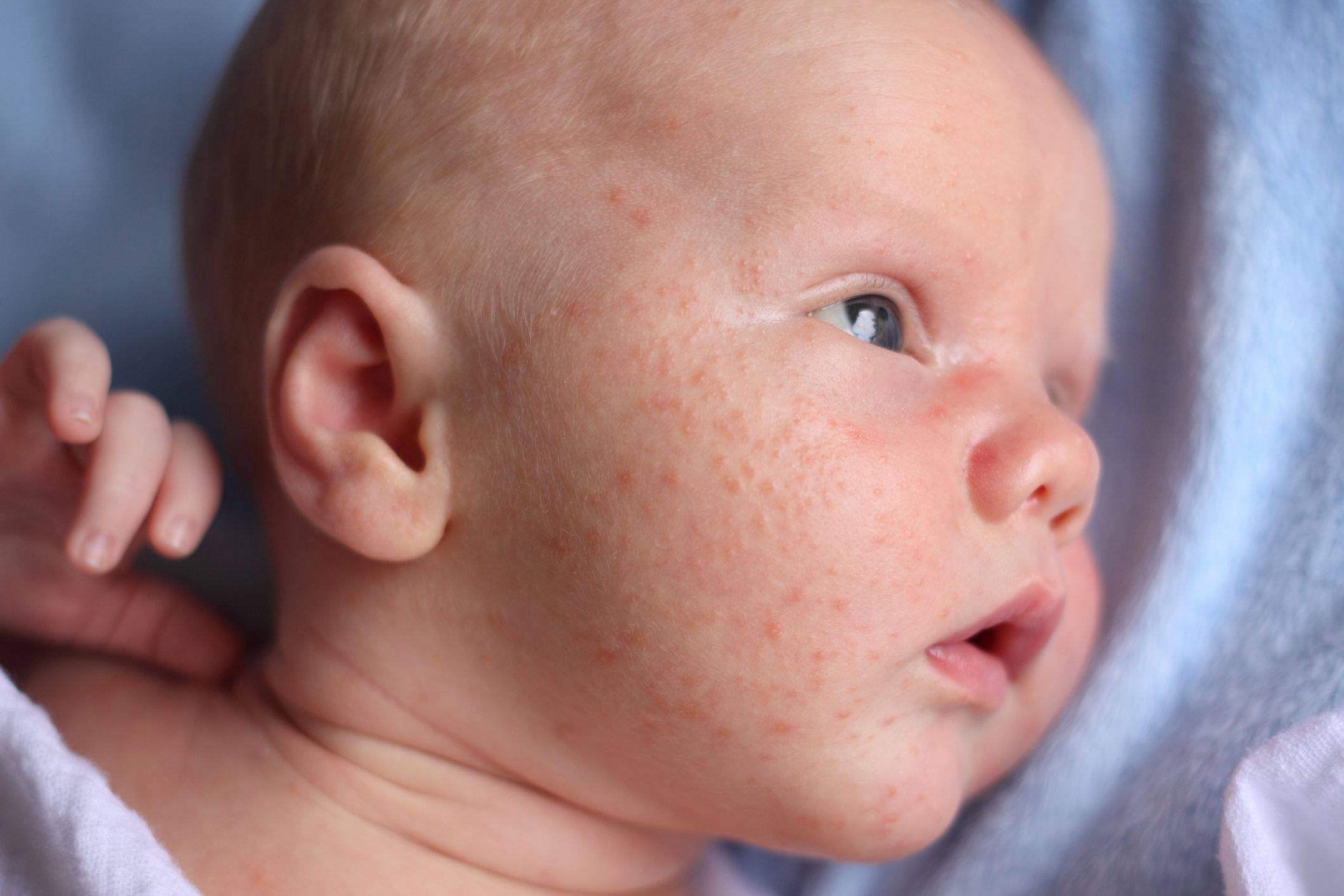Аллергия на белок коровьего молока у ребенка: как проявляется, симптомы аллергии на молоко | nutrilak