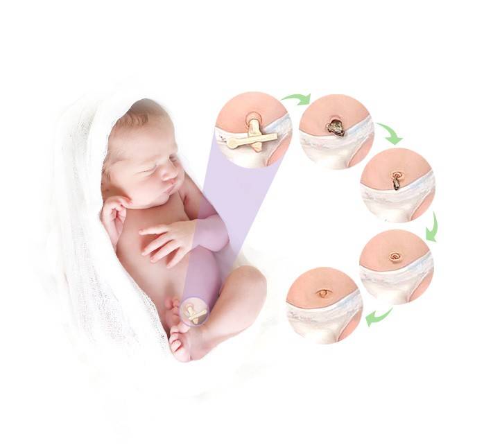 Как обрабатывать пупок новорожденного с прищепкой: важные правила