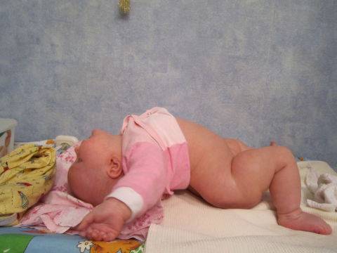 Почему возникает птоз у новорожденных и как его лечить - энциклопедия ochkov.net