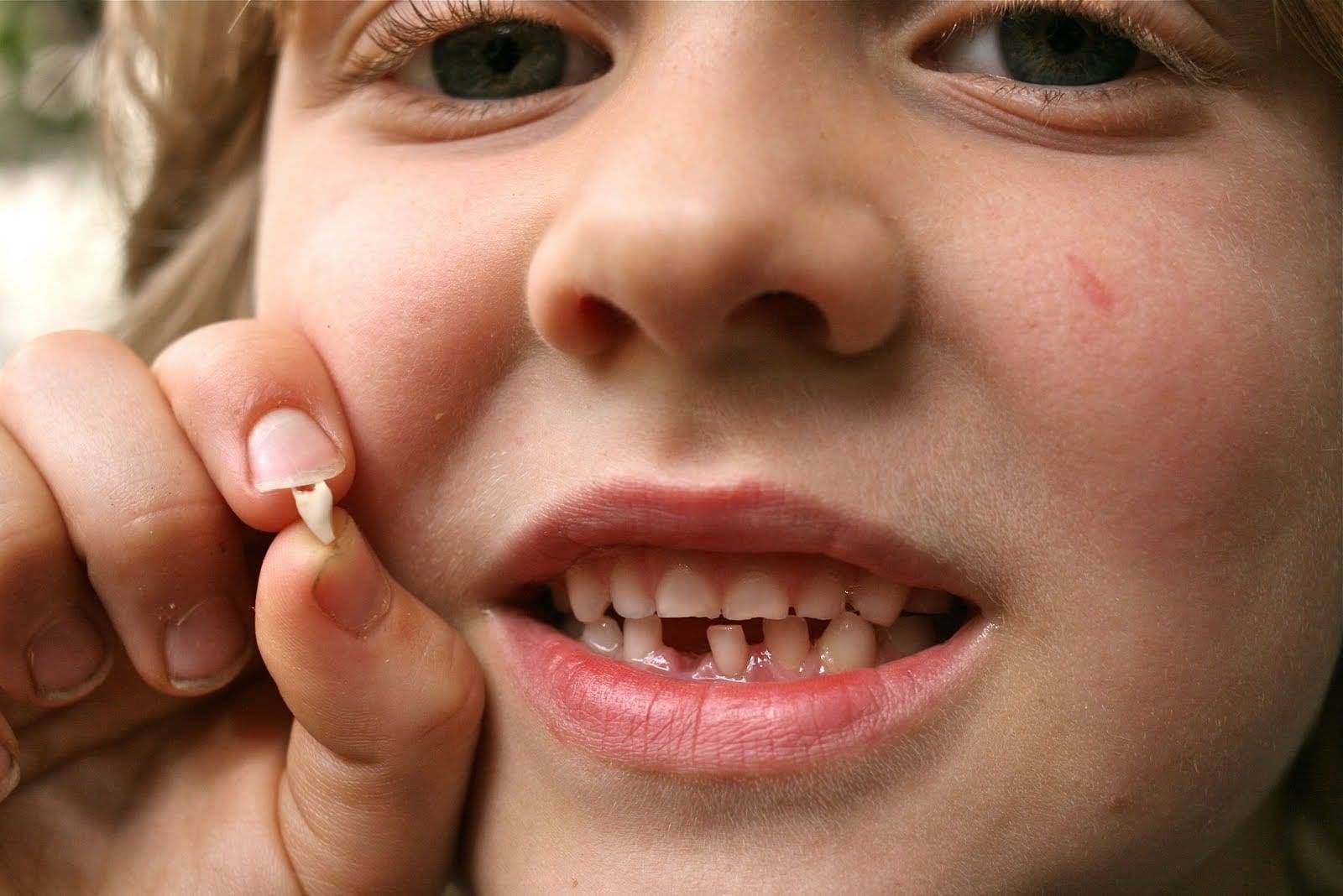 Травма молочного зуба: острая травма при ударе, травмы передних зубов у детей