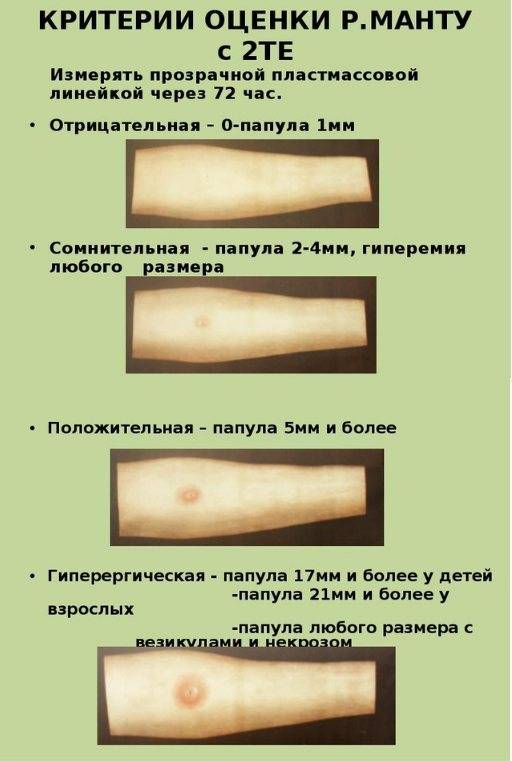 Диаскинтест взрослым. Туберкулиновая проба реакция манту. Проба манту реакция положительная папула 10мм. Диаскинтест папула синяя. Реакция манту в год нормы.