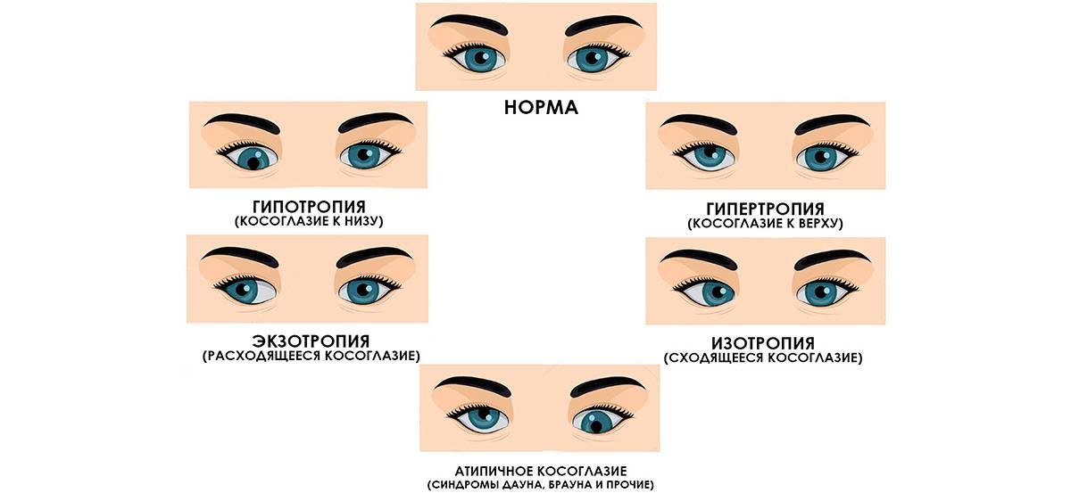 Косит глаз причины. Монолатеральное сходящееся косоглазие. Косоглазие степень зрения. Косоглазие у детей эзотропия. Схема сходящиеся косоглазие.