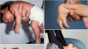 Гипертонус у младенцев | детский медицинский центр "чудодети"