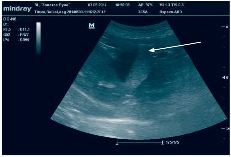 Взвесь в желчном. Гиперэхогенная взвесь в Водах. Гиперэхогенная взвесь в околоплодных Водах. Гиперэхогенная взвесь в околоплодных Водах на 20. Гипоэхогенное с взвесью жёлчный пузырь.