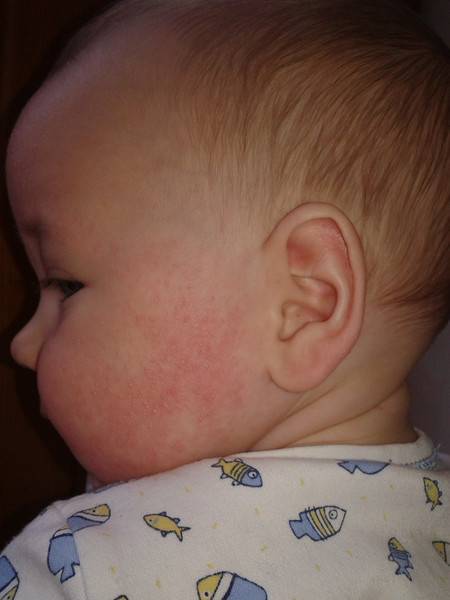 Диета ребенка, страдающего аллергией