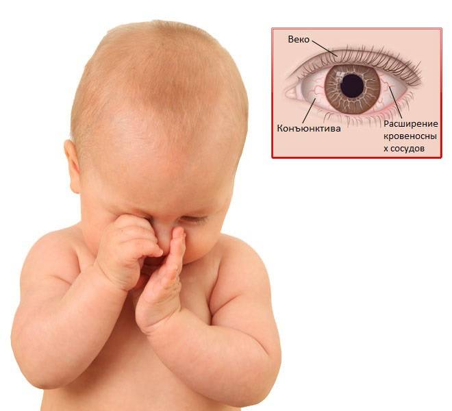 Почему у ребенка гноятся глаза? определяем основные причины самостоятельно