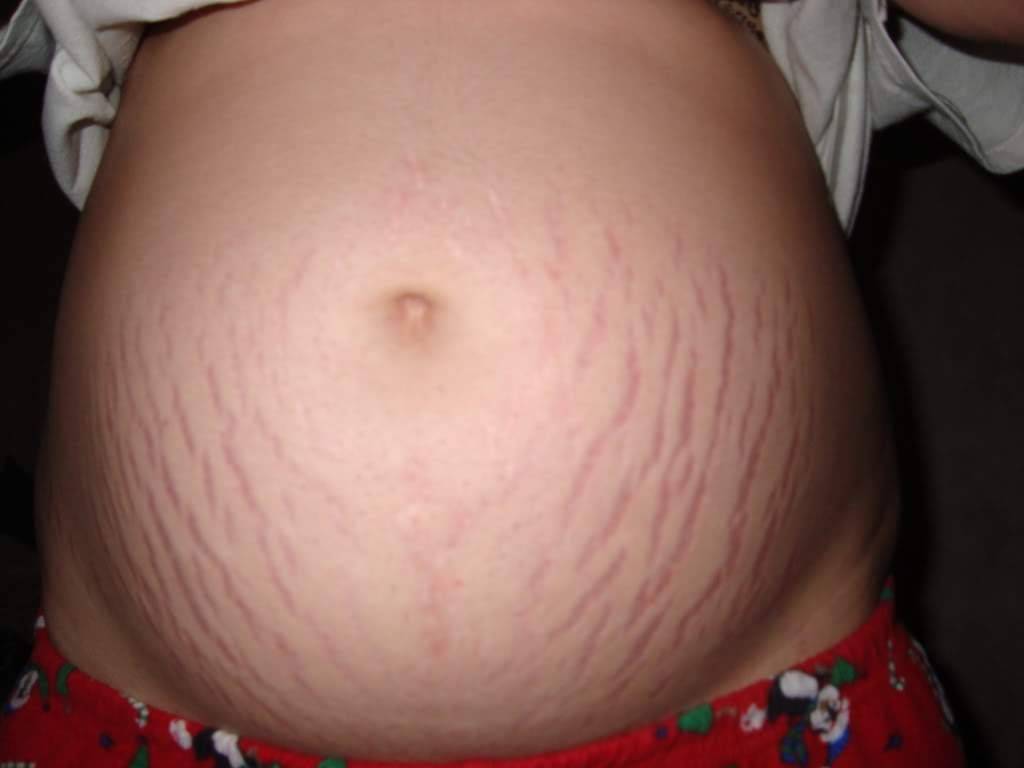 Профилактика и лечение растяжек при беременности