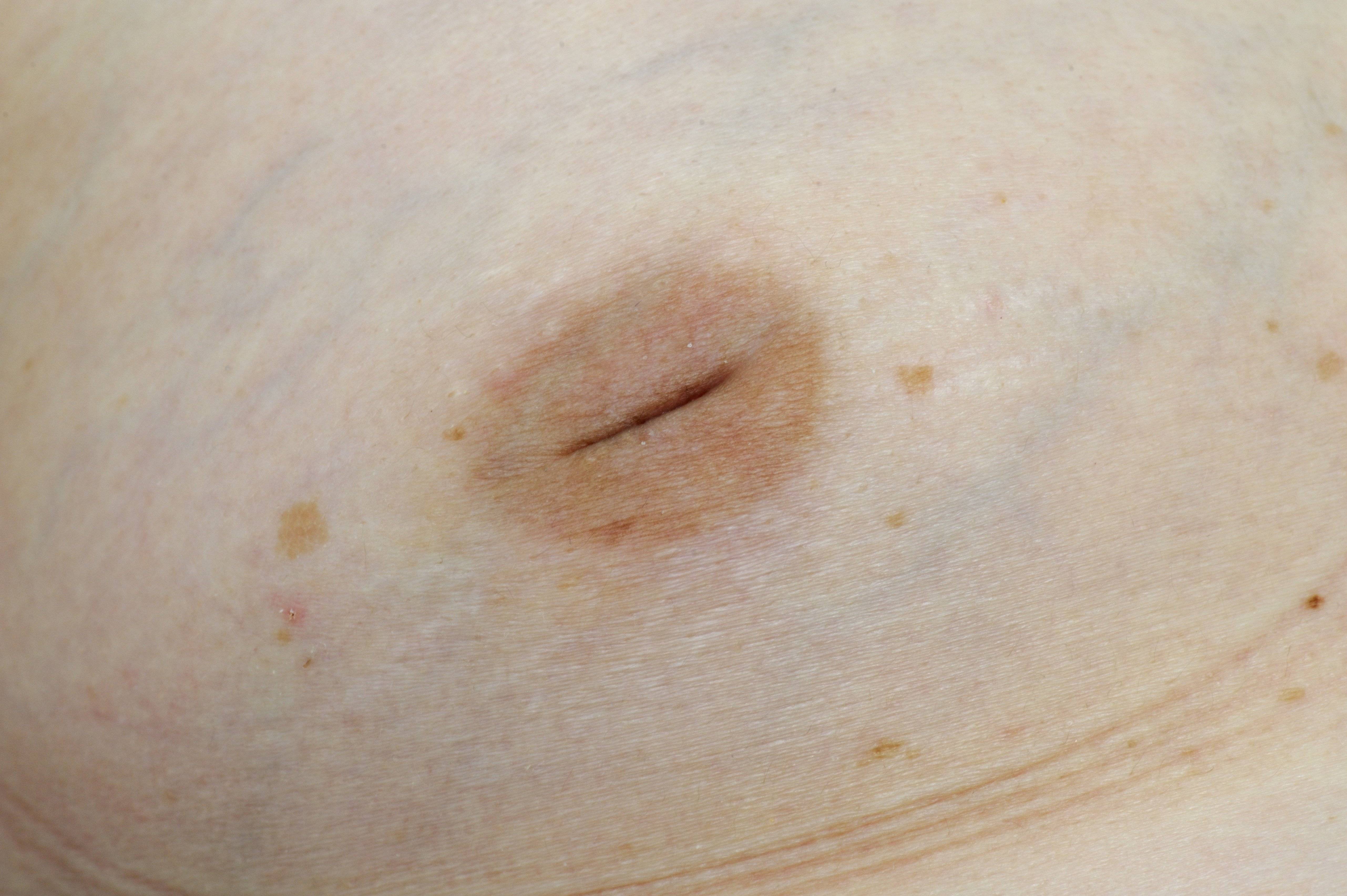 Реабилитация после маммопластики - уход за отеками груди, советы и ограничения