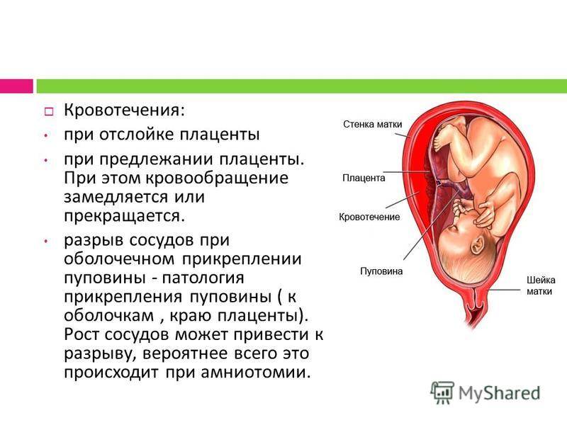 Отслойка плаценты | симптомы | диагностика | лечение - docdoc.ru