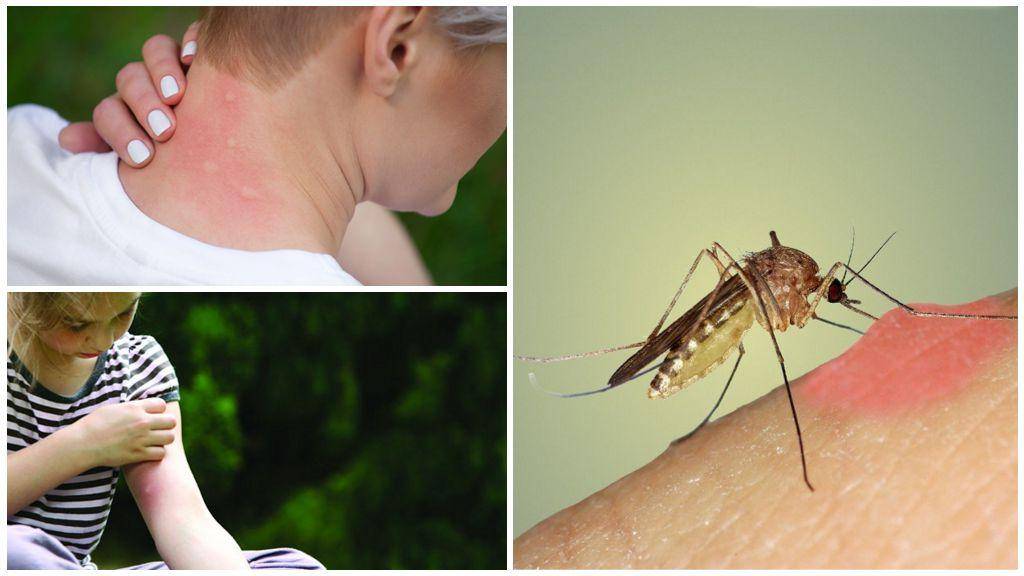 Укусы насекомых и инсектная аллергия