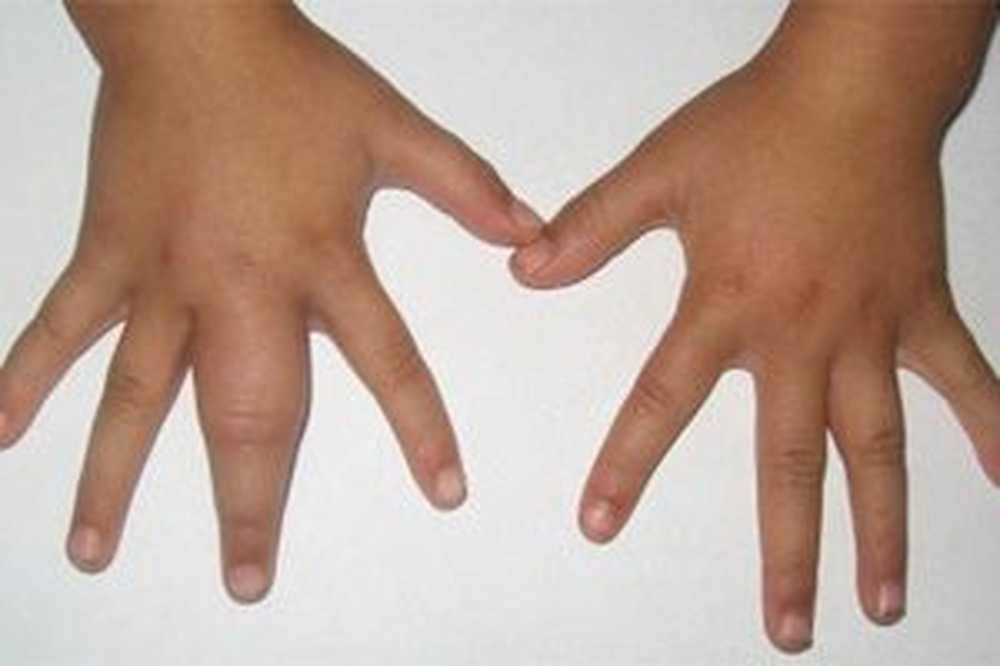 Отекают руки. причина отеков, диагностика, лечение отеков рук :: polismed.com