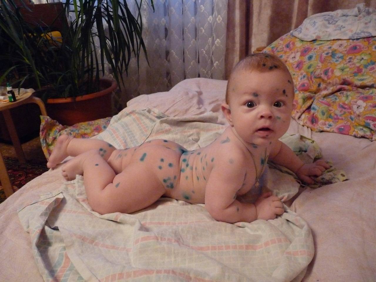 Ветрянка у детей
