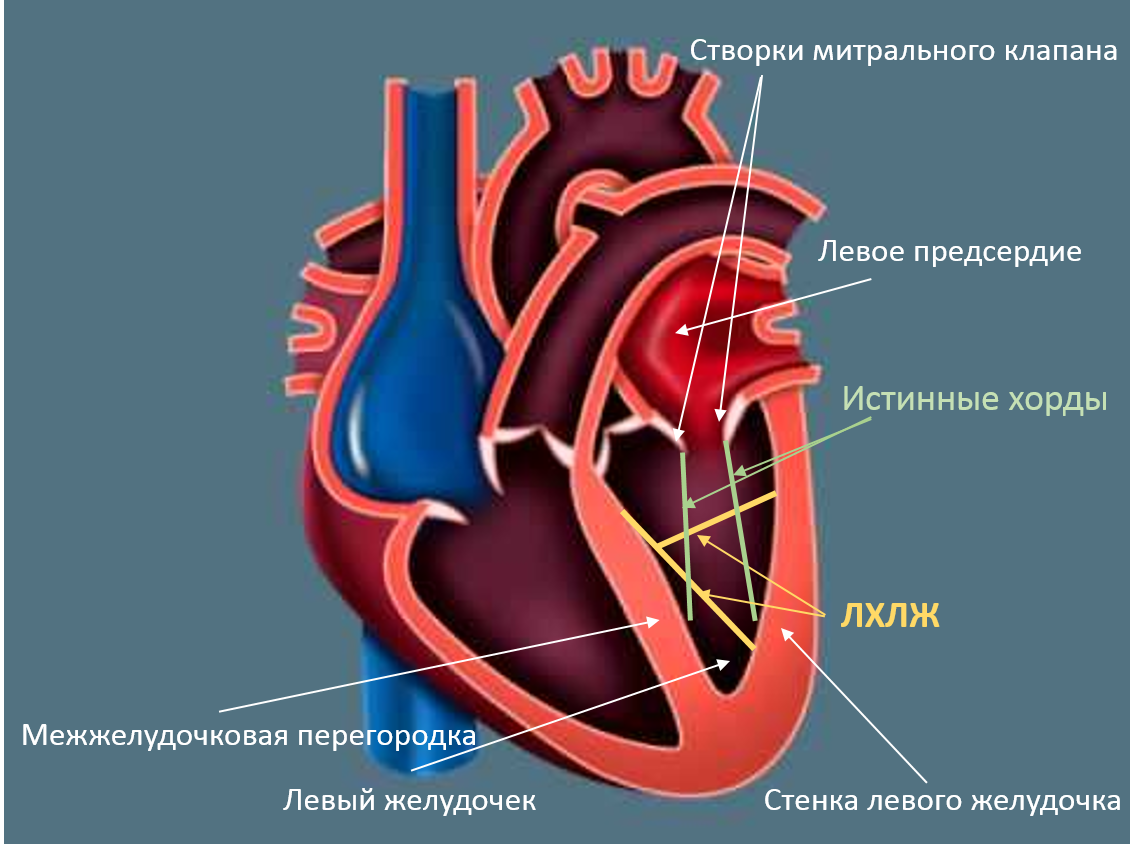 Наличие хорды у человека. Дополнительная хорда в левом желудочке сердца. Дополнительная хорда митрального клапана. Хорда левого желудочка сердца. Ложная хорда левого желудочка у ребенка.