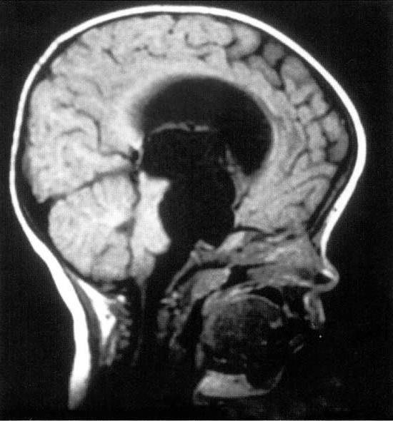 Ретроцеребеллярная киста головного мозга (арахноидальная) - понятие, опасна ли, проявления, как лечить