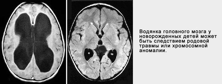 Нейросонография – ультразвуковое сканирование головного мозга
