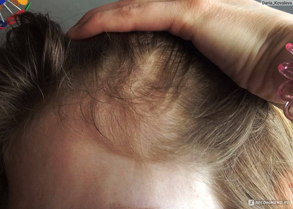Выпадают волосы при гв | причины выпадения волос при кормлении грудью