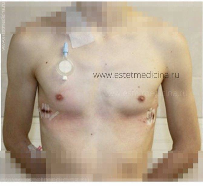 Деформация грудной клетки у детей: причины, симптомы, лечение - beautyvertebro.com