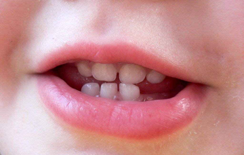 Что полезно знать об удалении молочных зубов у детей?