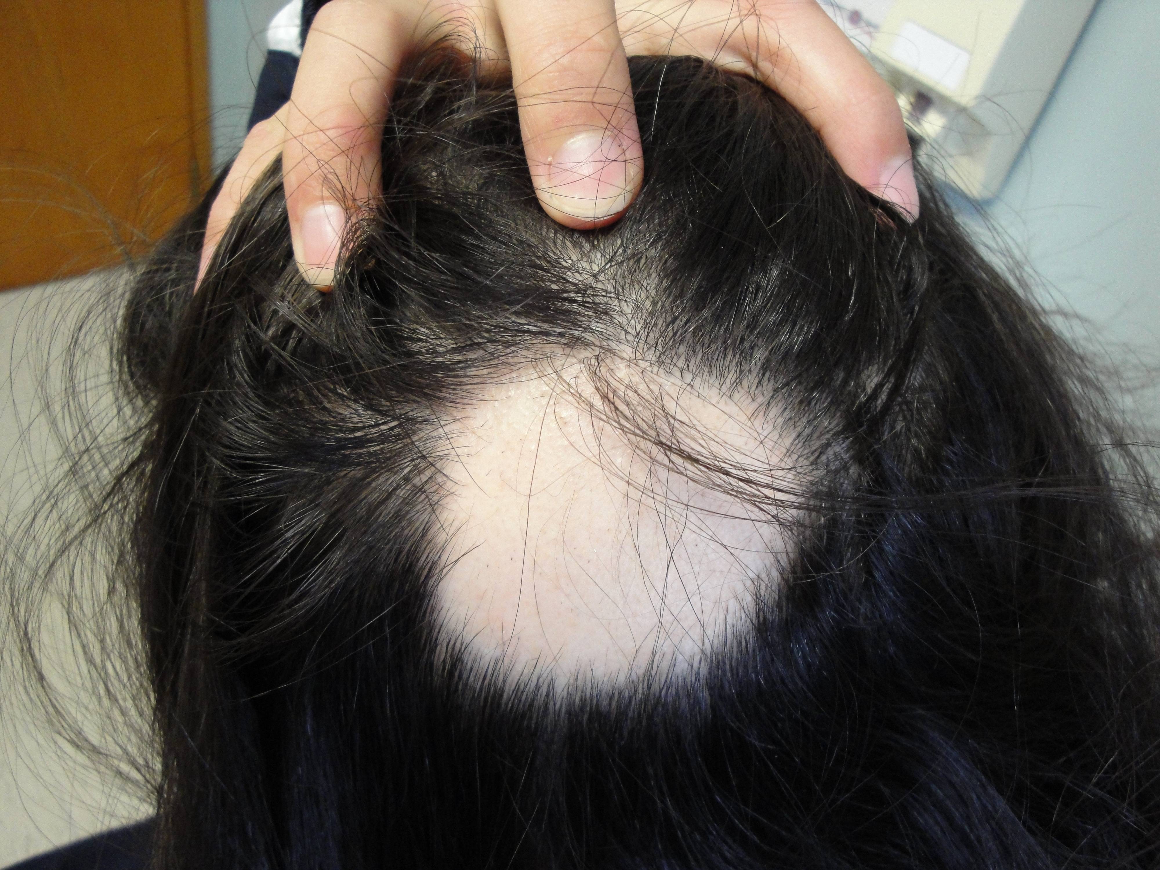 Выпадение волос на фоне стресса у женщин, как его остановить?